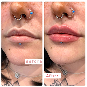 Injizierbare 1 ml 2 ml 3 ml 5 ml vernetzte Hyaluronsäure-Injektionen Hautfüller/Ha-Füller für Lippen, Nase, Falten, Brust, Gesäß, Körper, Gesicht, Hals, Falten