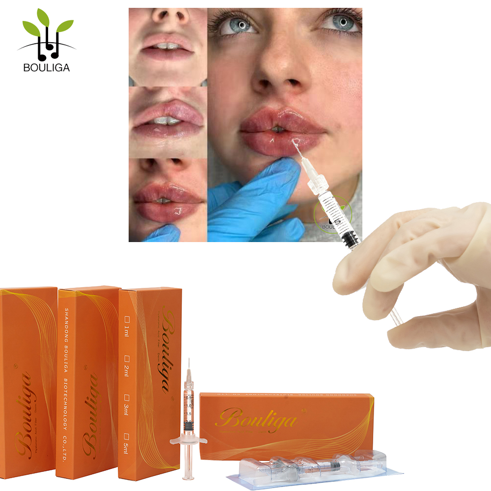 Bouliga Superior Hyaluronsäure-Hautfüller, 5 ml, nicht-chirurgischer Lippenfüller