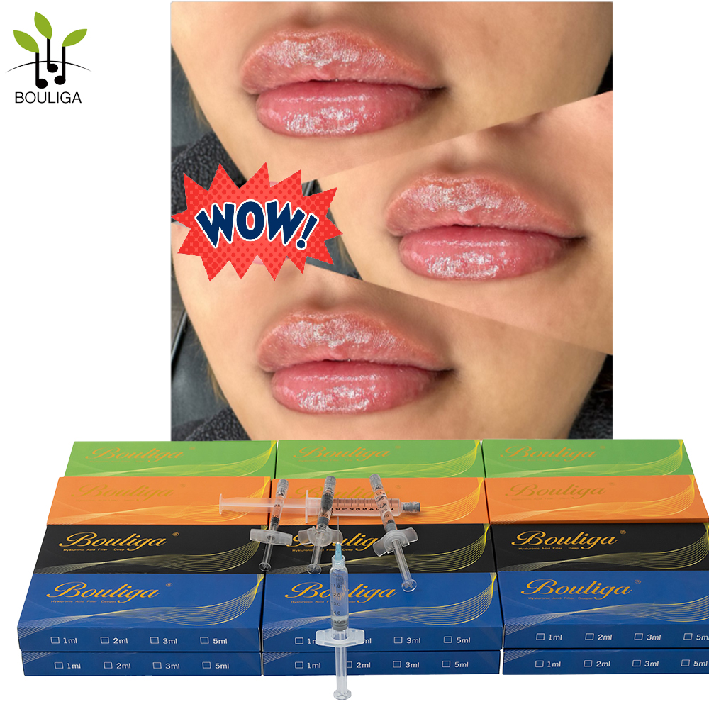 Bouliga Voluminöse Lippen Hyaluronsäure-Filler – 1 ml, 2 ml, 5 ml, 10 ml